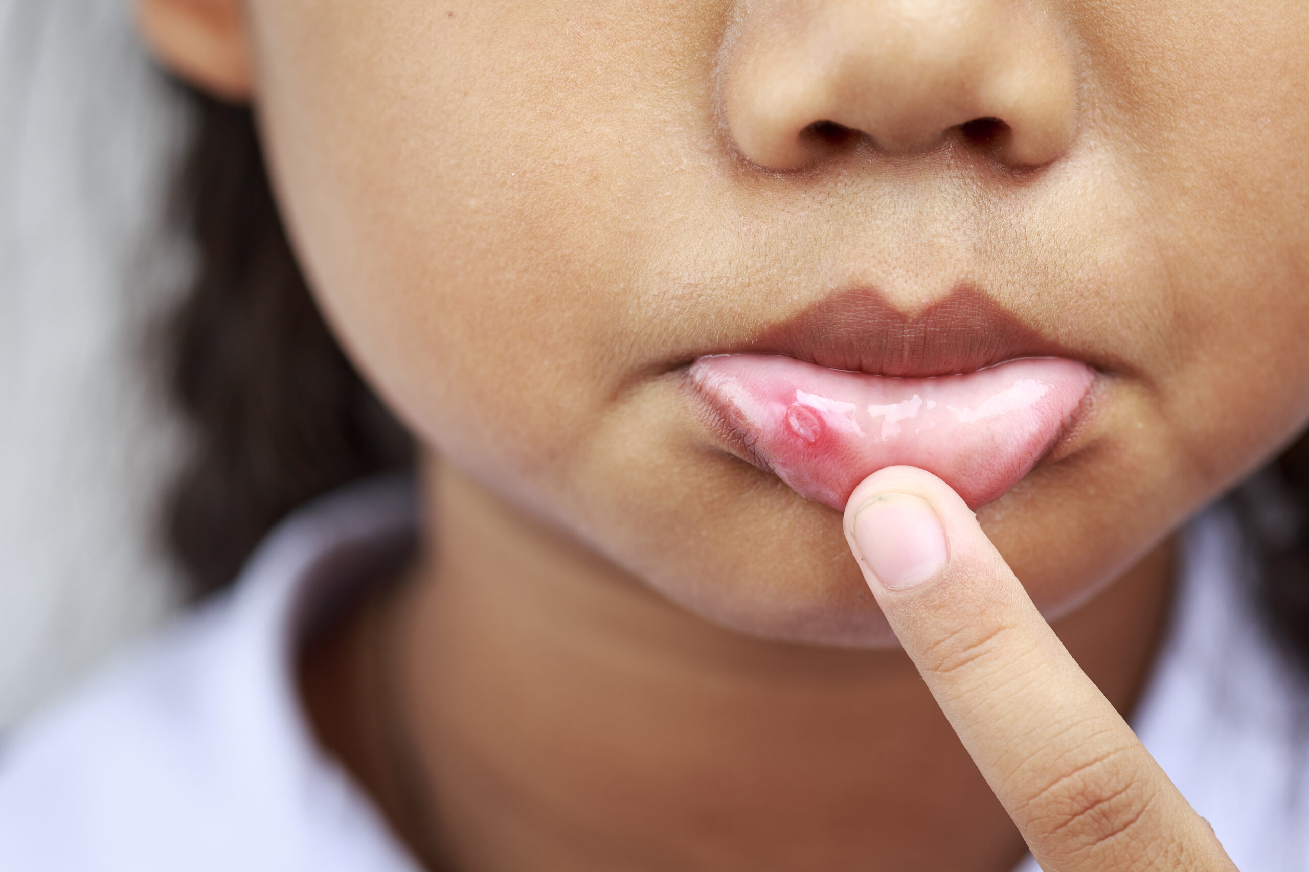Les aphtes sont de petites ulcérations douloureuses qui apparaissent à l'intérieur de la bouche. Généralement sans gravité, ils peuvent se révéler très gênants, tant pour les adultes que pour les plus jeunes. Quelles en sont les causes? Quel traitement pour s’en débarrasser au plus vite? Découvrez tout ce qu’il faut savoir sur les aphtes!